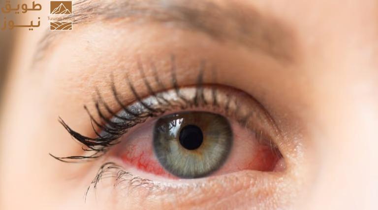 You are currently viewing 4 نصائح لتجنب جفاف العين.. “شرب الماء” عامل مهم