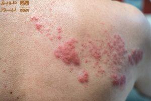 Read more about the article حملات توعوية لتصحيح المفاهيم الخاطئة حول الحزام الناري وتعزيز التوعية بطرق الوقاية منه .. بمناسبة الأسبوع العالمي للتحصينات