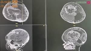 Read more about the article مستشفى الدكتور سليمان الحبيب بالقصيم ينجح في استئصال ورم دماغي ضخم وينهي معاناة “حديثة ولادة”