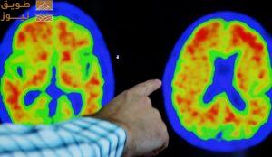 Read more about the article دراسة: كبسولات صغيرة تسعى للحد من التهاب الدماغ