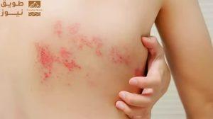 Read more about the article استشاري: التهاب فيروس الحزام الناري يسبب آلامًا شديدة للأعصاب
