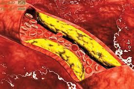 You are currently viewing ارتفاع الكوليسترول الضار.. مخاطر يجب الانتباه إليها